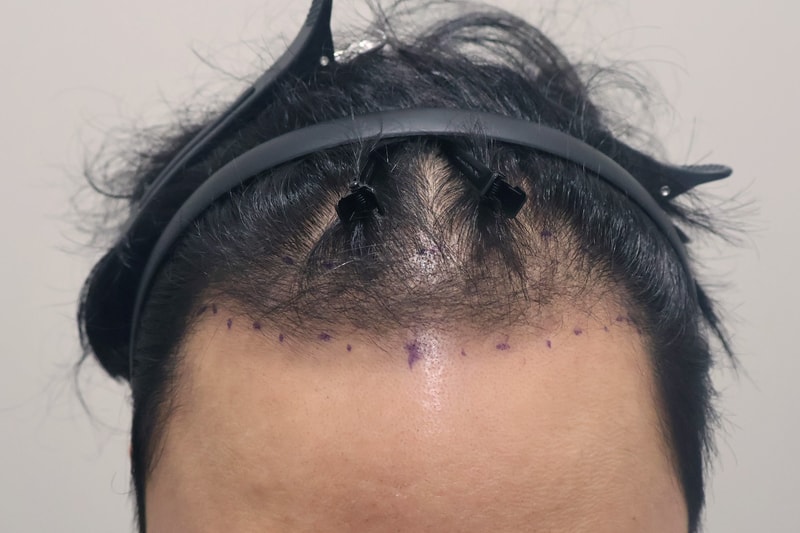 인천 마이모 비절개 2400모 6개월 후기
