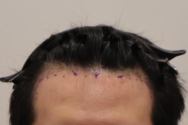 부산 헤어로의원 비절개모발이식 1100모낭 1달 경과 보고 왔습니다