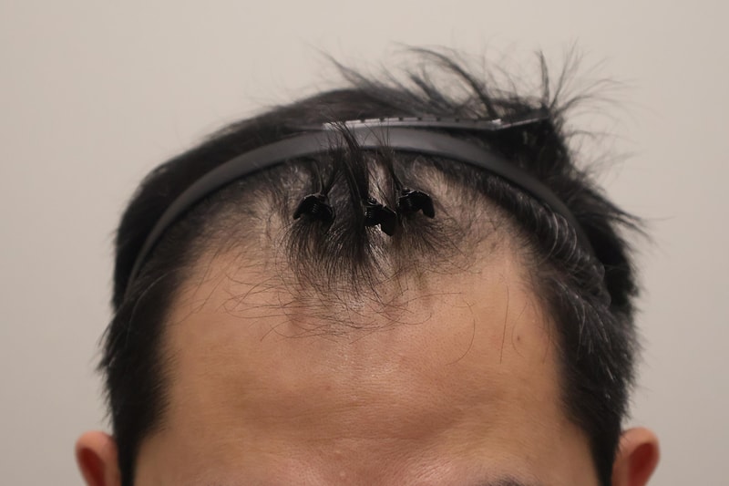인천 마이모의원 2600모 비절개 모발이식 3개월차 후기