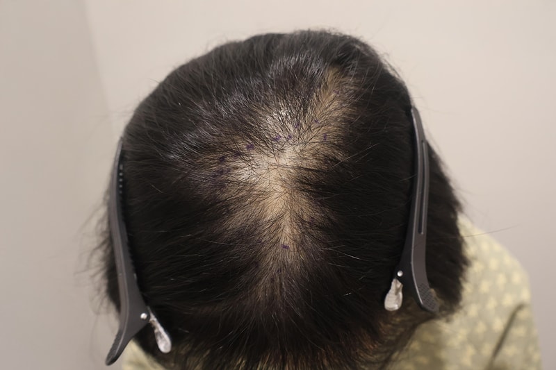 The third review of the sprout in a month after transplanting 1,200 hairs on the top of the head in Maimo, Incheon