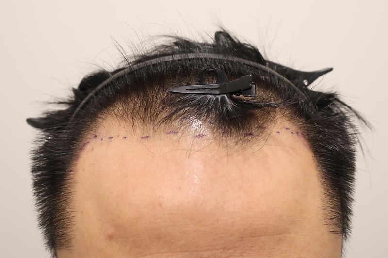 Busan Hair Clinic's non-cut hair transplant 1,200 hair follicles for about two weeks