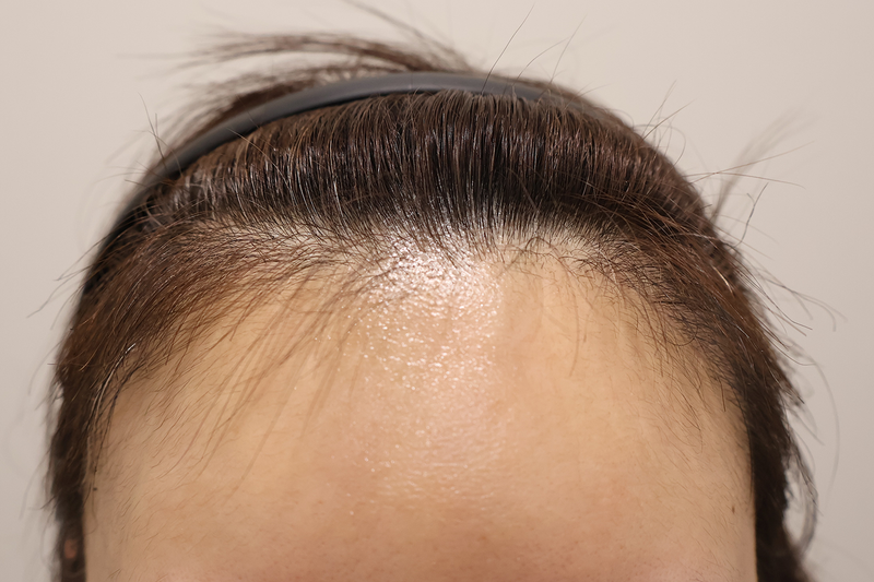 Incheon Maimo Clinic 800 hair follicles for 3 months