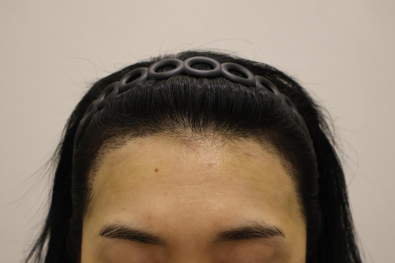 2000 Mo 10 Days Late of Hairline Correction Received by incision with Dongtan Hair