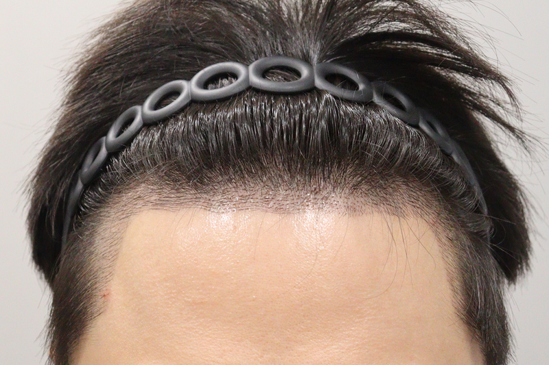 차태완_2주경과 9.png