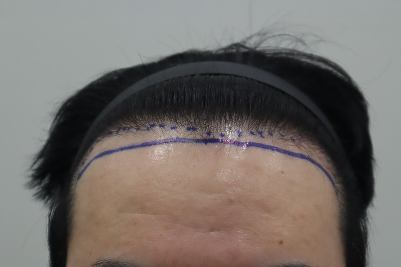 HAIRO HAIR TRANSPLANT CENTER Jeonju Non-Cutting Hair Transplant 2,400 Maternal Transplantation 2 Weeks Later