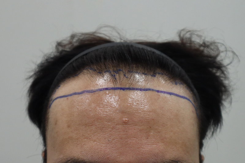 Jeonju Hair Orthopedic Clinic Non-Cutted Hair Transplantation 4000 Mo 2 weeks have passed