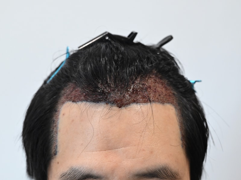 수술후2.jpg