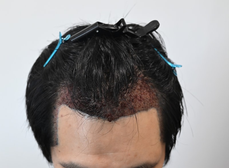 수술후1.jpg