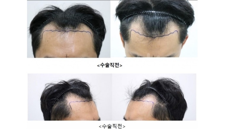 [모스트] 비절개(노컷+라인컷) 3,500모 모발이식 평가(6개월 경과)
