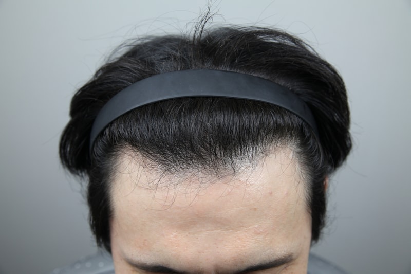 비절개 2500모 이식
