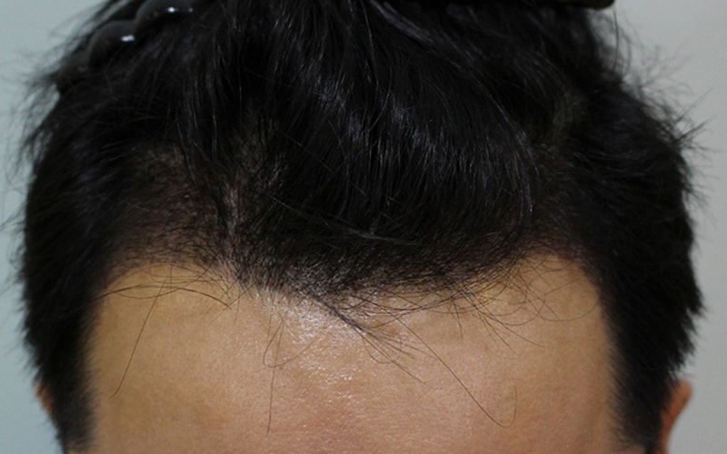 수술후 8일 (6).JPG
