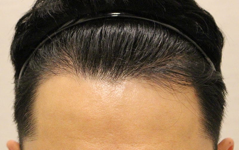 수술후 6개월 (3).JPG