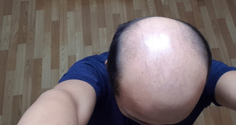 매우 심한 탈모인의 모발이식수술 1일차 후기