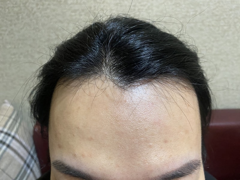 뉴헤어 비절개 슬릿 부분삭발 3400모 수술 후기입니다.