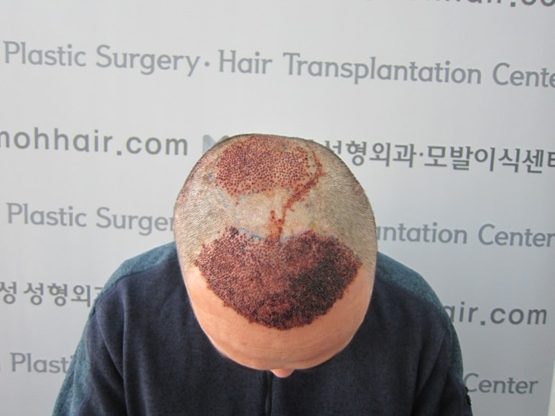크기변환_수술 1일차.JPG