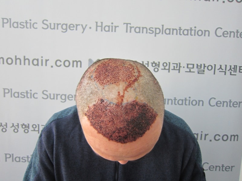 크기변환_수술 1일차.JPG