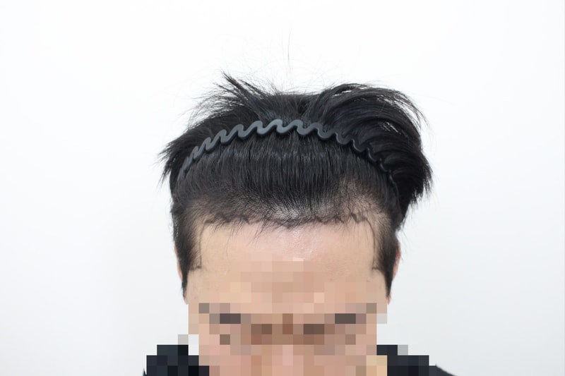 ☆신사역 모프로의원, 측면 포함 모발이식, 1년 경과☆