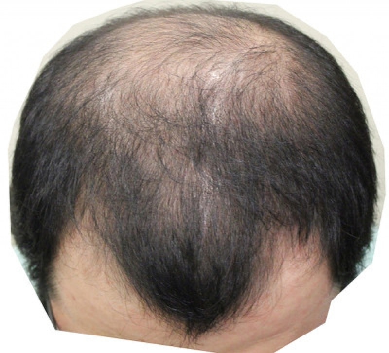 JP성형외과 5900모 1년2개월째 후기..