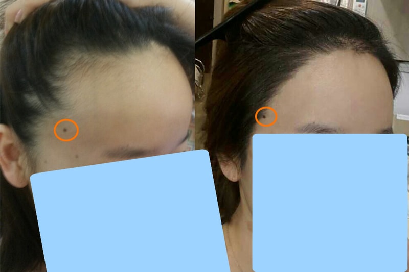 수술전후3.jpg