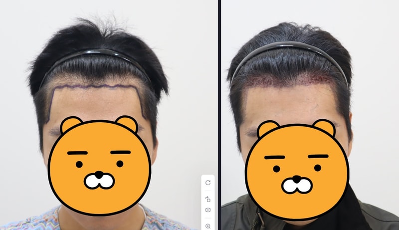 밴스모자이너 m자탈모 비절개 후기입니다