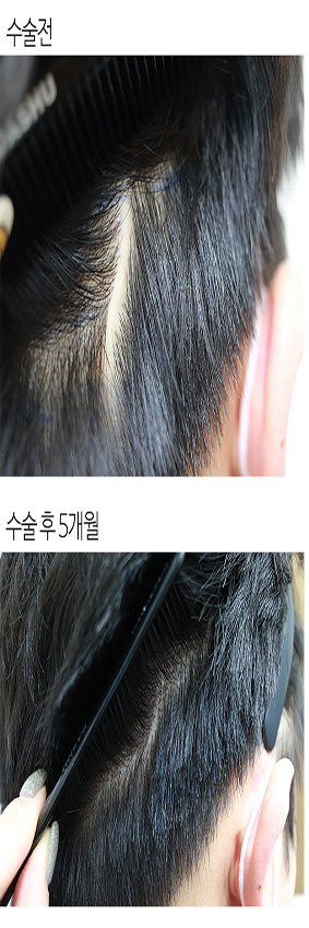 흉터전후_1.jpg