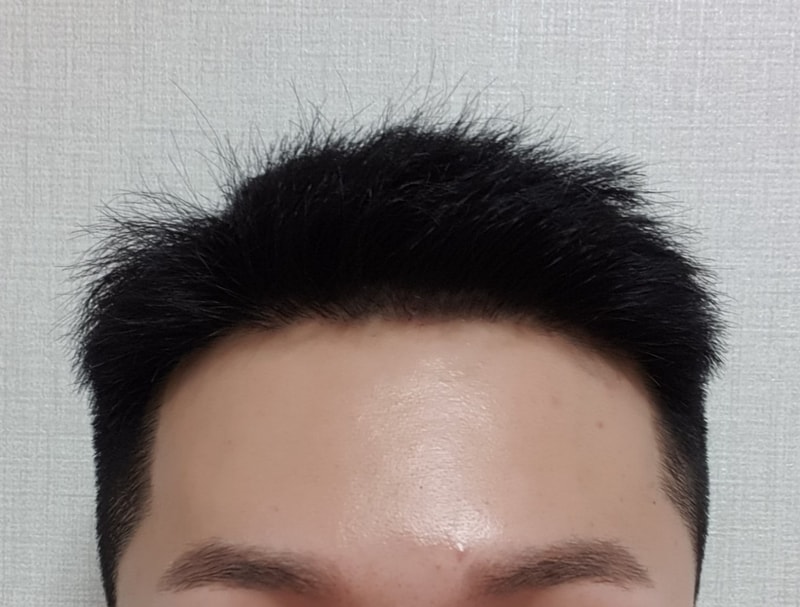 수술 234일(약 8개월) 경과 사진 첨부합니다^-^