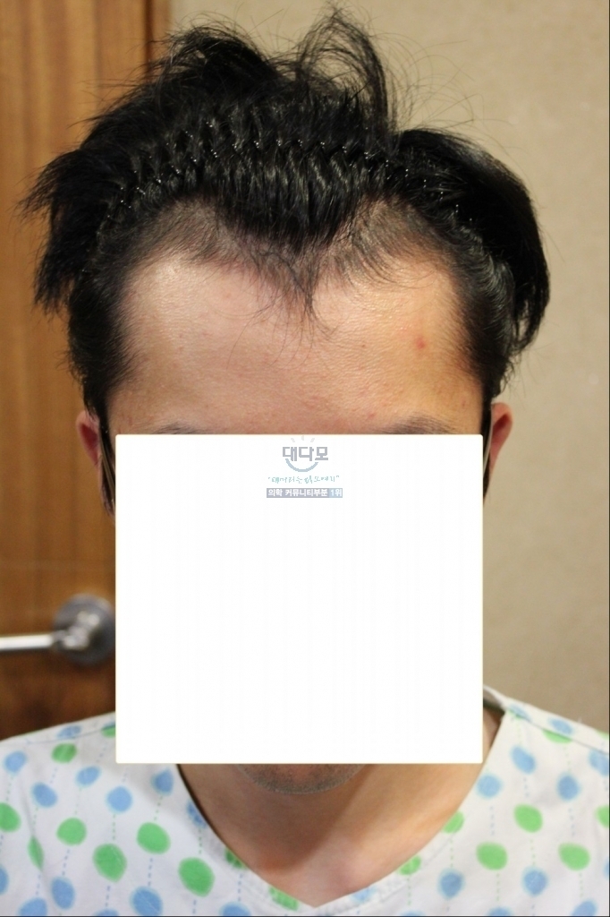 JP모발이식 AS후 9개월차