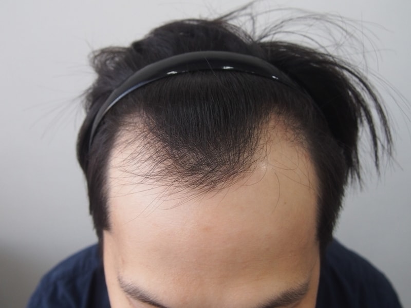 It's the third day of non-excisional transplantation on the 22nd.