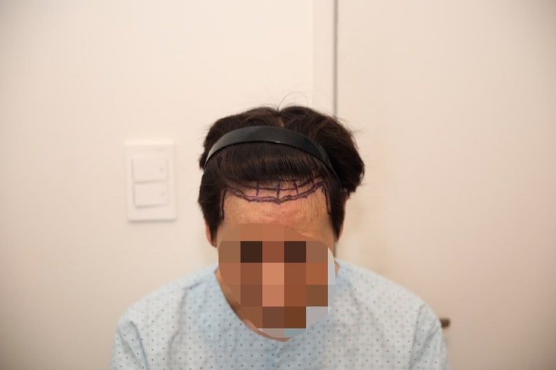 This is a review of the new hair transplant.