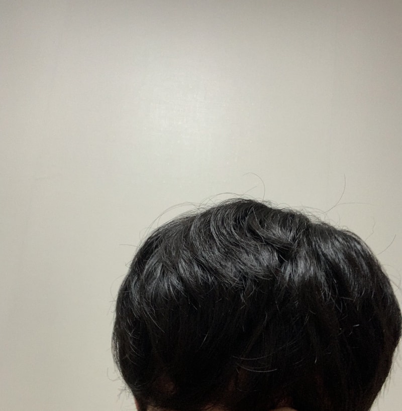 New Hair 1 Year 2 Months of Surgery Review