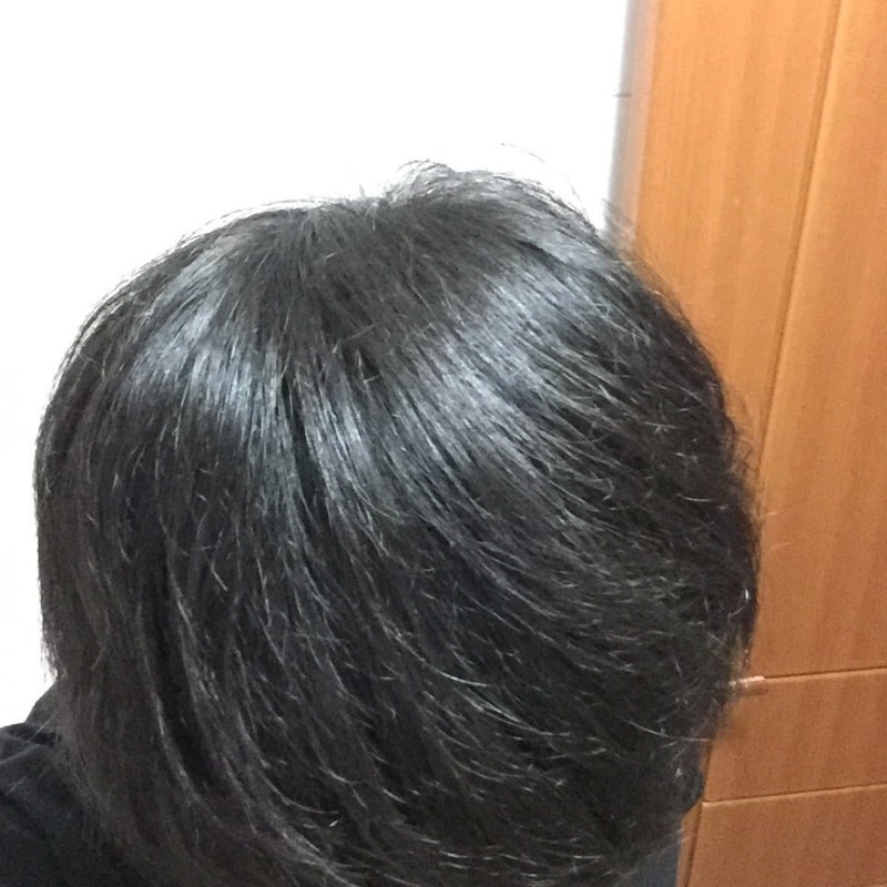 모재성 비절개 1800모낭 수술 4개월차