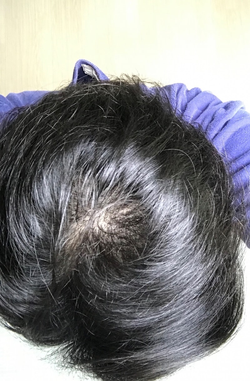 대량이식  다나 6개월