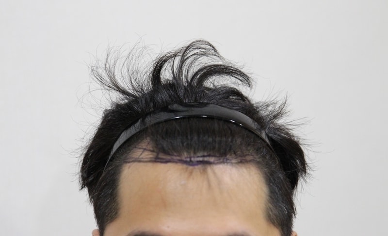 뉴헤어 수술후기 입니다