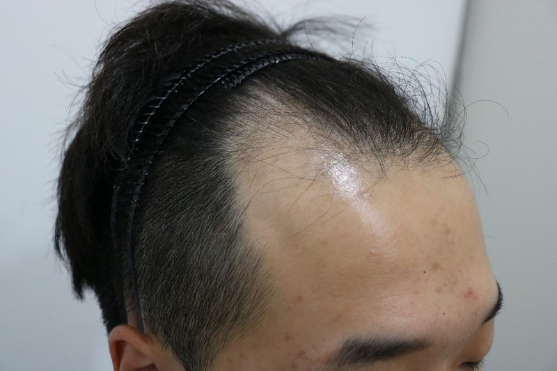 수술전.jpg
