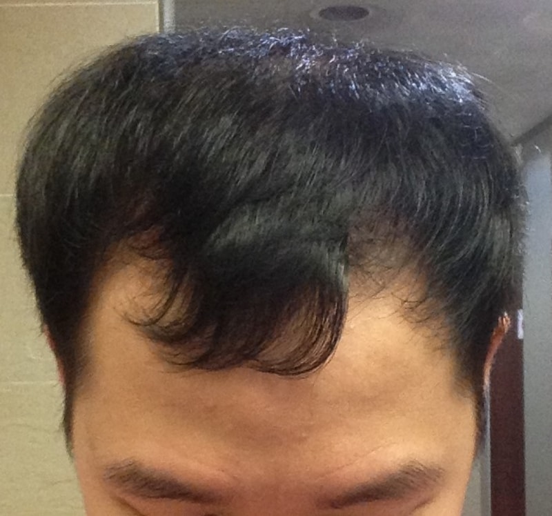 이식 초창기.jpg