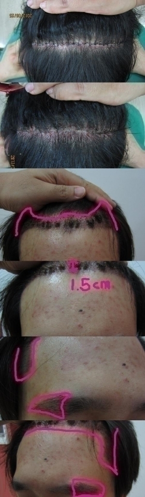 후두부 수술경과 사진 종합2.JPG