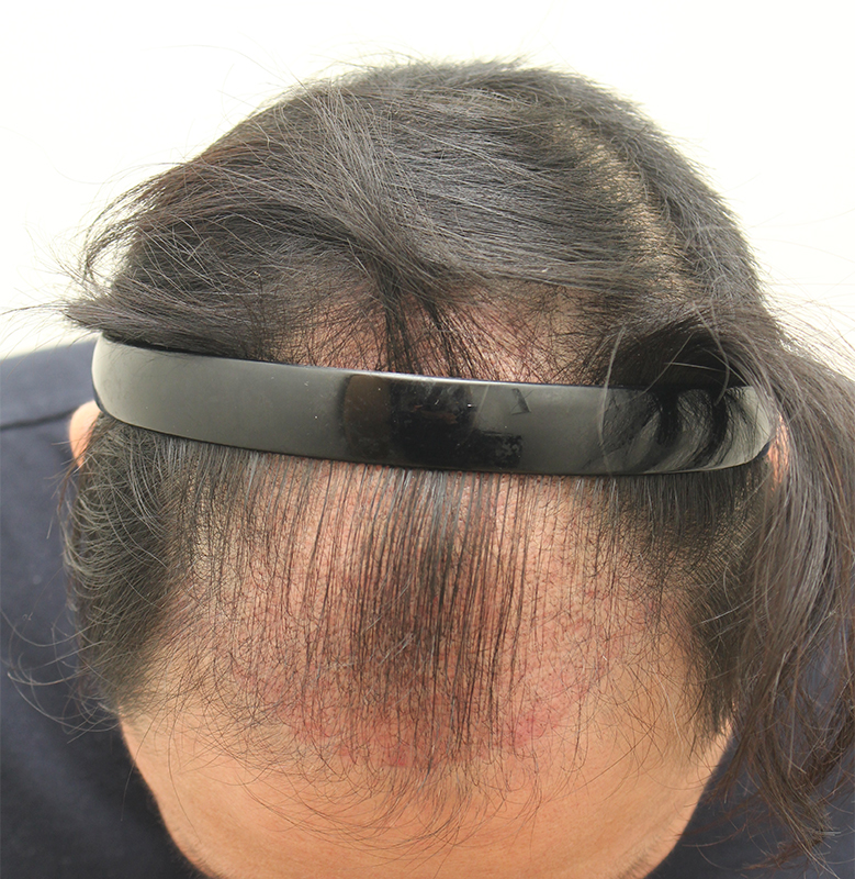 3.수술후45일째.jpg
