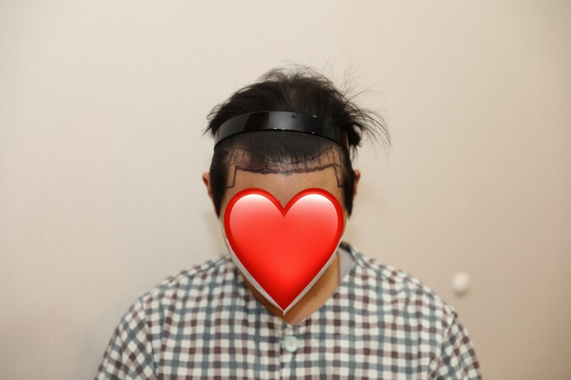1500+@ 모낭 M자 이마 모발이식 후기