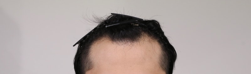 수술전.jpg