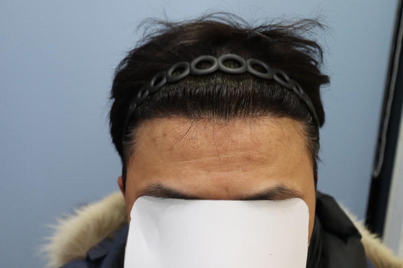 수술후 6개월 후기