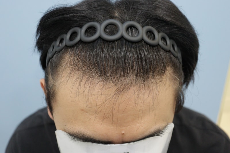 광주압구정모비앙 모발이식 1년 경과 후기