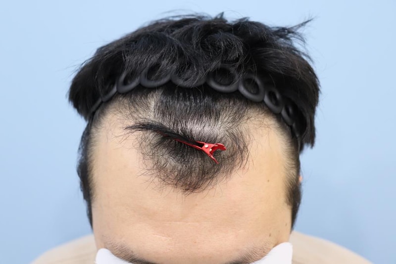 광주 압구정모비앙 1년 모발이식 후기