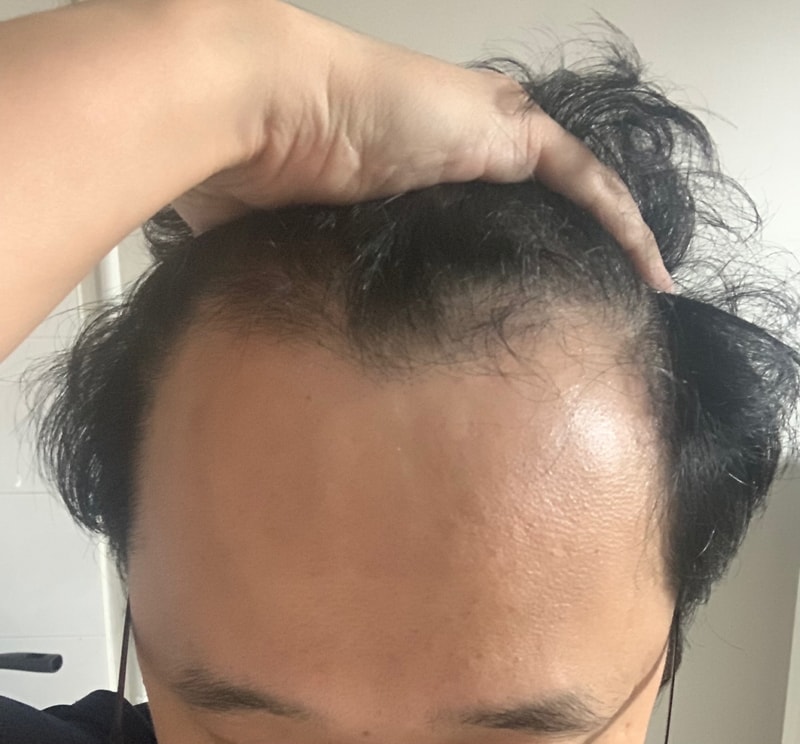 광주압구정모비앙 모발이식 2주차 후기