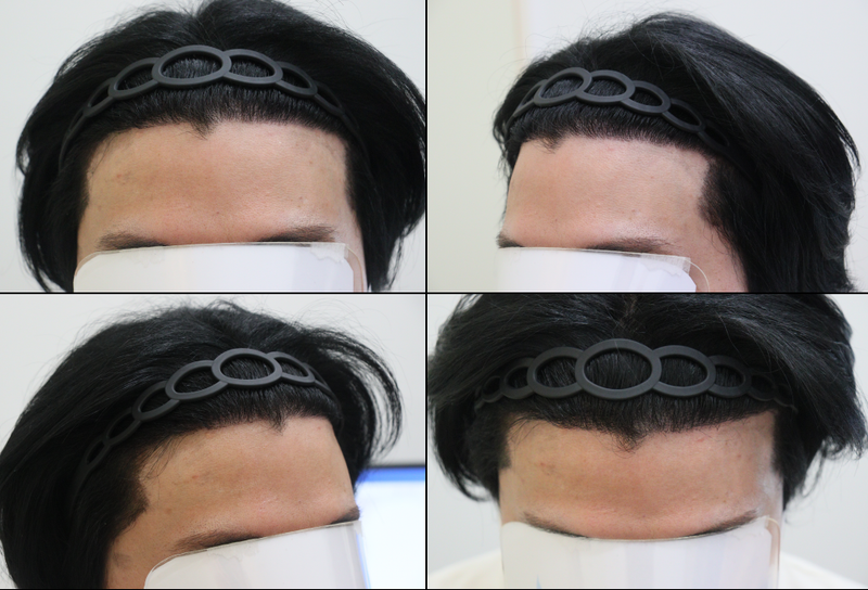 광주 압구정모비앙 6개월 모발이식 후기