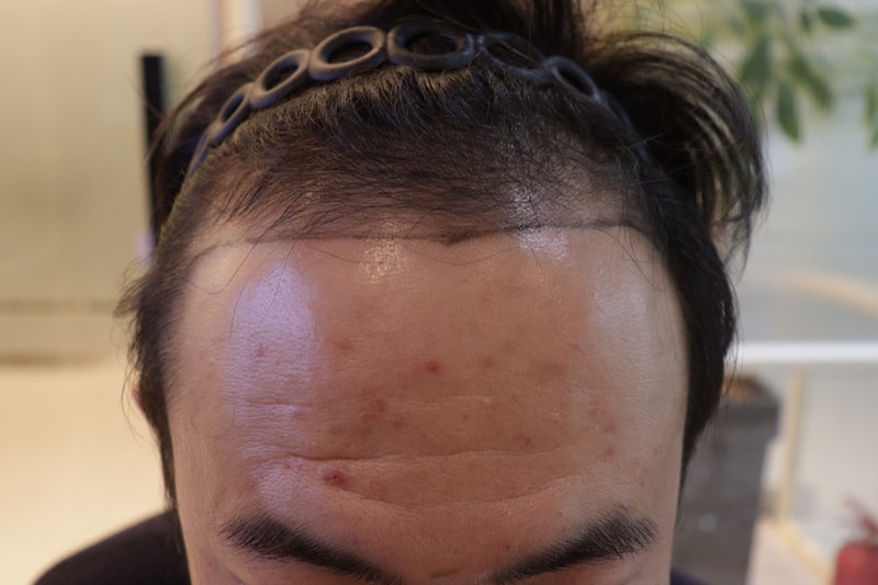 이식전 2.jpg