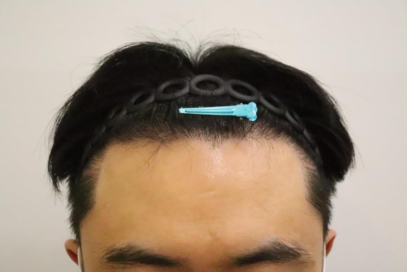 남자 m자 탈모 6개월 후기입니다.