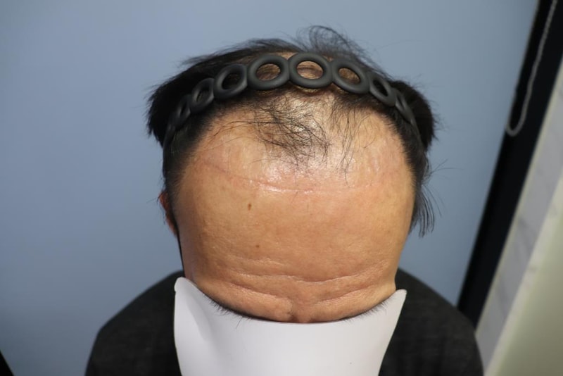 광주 압구정모비앙 6개월 모발이식 후기