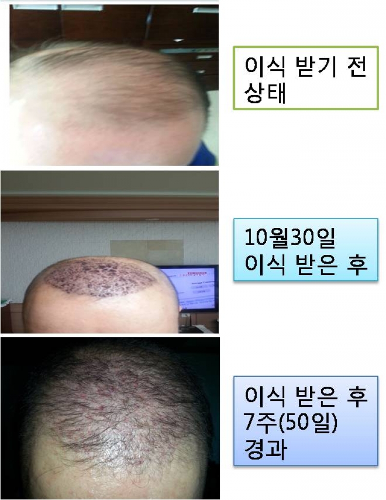 비절개방식 2500모낭 7주(50일) 경과 후기 입니다.^^ -2차후기