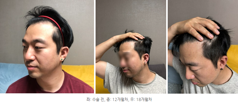 왼쪽이마라인.png
