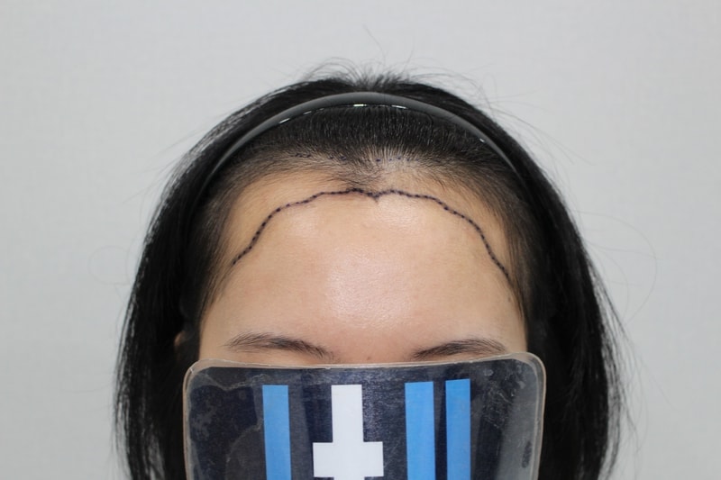 Moderhamm Clinic — Hair Transplant Center, Women's Forehead Height + Review the Day After Emza Surgery